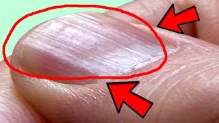 What Causes Ridges in Finger and Toenails [upl. by Ymaral619]