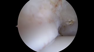 Anteromedial Soft Tissue in the Ankle after Removal of Impingement [upl. by Idelle240]