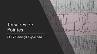 Torsades de Pointes ECG Findings Explained [upl. by Jerman]