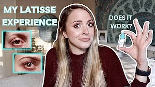 MY EXPERIENCE WITH LATISSE AND 4 MONTH RESULTS  Mistakes to avoid amp Is it worth the hype and money [upl. by Eigna]