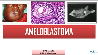 Ameloblastoma  Benign Odontogenic Tumor [upl. by Ajup]