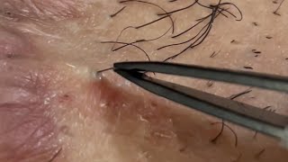 Ingrown hair removal [upl. by Lowndes]