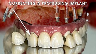 Correcting a Protruding Implant [upl. by Mhoj]