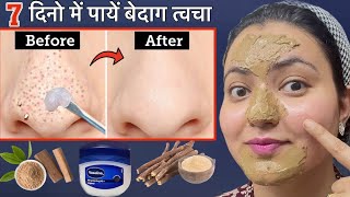 कितने भी जिद्दी Blackhead Whitehead कील सफेद दानेClogged Pores Scars हों इस Remedy से होगा कमाल💕 [upl. by Anwahsal]