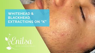 Enilsa is back Whitehead amp Blackhead Extractions on quotKquot  Part 1 [upl. by Apfel]