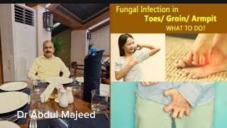 fungal infection in groin toes Armpit what to do [upl. by Daugherty]