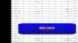 EEG OSCE [upl. by Dickie]