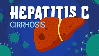 Hepatitis C amp Cirrhosis  symptoms diagnosis amp treatment [upl. by Yllod]