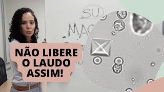 COMO LAUDAR SUMÁRIO DE URINA CORRETAMENTE Sedimentoscopia [upl. by Ahsiuqel904]