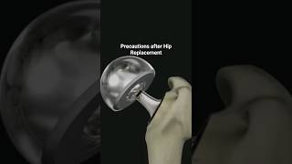 Posterolateral Hip Replacement Precautions [upl. by Jessamine]