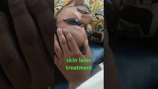 skin laser treatment besthairtransplant besthairPRP besthairGFC [upl. by Janet193]