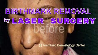 BirthMark Removal Nevus of Ota Laser Removal Philippines and Asia [upl. by Cirdek]