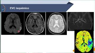 Imagenología del Sistema Nervioso Patologías [upl. by Neyud339]