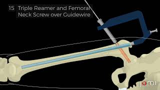 Carbon Fiber Implant for Fixation of a Pathologic Subtrochanteric Fracture Steps [upl. by Ymar18]