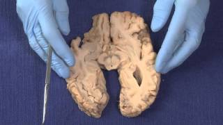 Basal Ganglia Neuroanatomy Video Lab  Brain Dissections [upl. by Selena252]