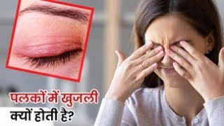 Blepharitis आँखों की सुजान और उसका इलाज [upl. by Ellery26]