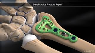 Distal Radius Fracture Repair [upl. by Jerrilee]