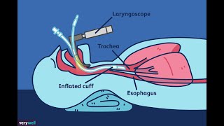 Intubation difficile  Live démonstration  AIRWAY [upl. by Maleen994]