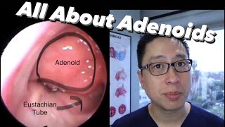 Adenoids and Adenoidectomy what are they when do we remove them what is the surgery like [upl. by Llenyl197]