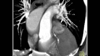 4D Imaging of the Aortic Valve Dilated aortic root 2 of 6 [upl. by Seuqramed]