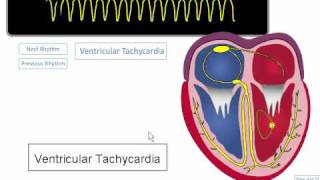 ECG Rhythm Review Ventricular Tachycardia Torsades de points Asystole [upl. by Pollitt]