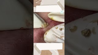 Big Cystic Acne Blackheads Extraction Blackheads amp Milia Whiteheads Removal Pimple Popping shorts [upl. by Flita]