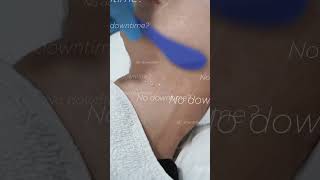 Nonsurgical longlasting lift with zero downtime💛 Ultherapy facelift liftandtighten collagen [upl. by Ytsirk]