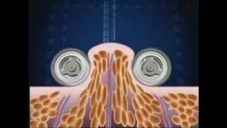 How Endermologie® works lipomassage [upl. by Ermeena561]