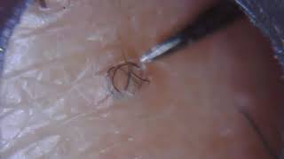 Long ingrown hair removal 23 [upl. by Nyllij360]