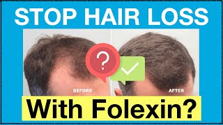 How Does Folexin Really Work To Stop Hair Loss Naturally See Our FolexinFoligen Review [upl. by Ferguson889]