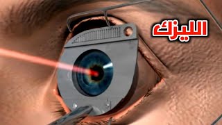 شاهد كيف تتم عمليه تصحيح النظر بالليزرالليزكWatch laser vision correction surgery LASIK [upl. by Kohn]