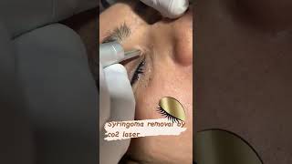 SYringoma removallaser treatmentlaserco2laser [upl. by Hailat]