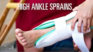 High ankle sprain Signs symptoms and treatment of a syndesmosis injury [upl. by Onateag]