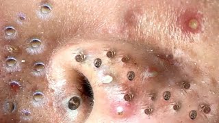 blackheads new 2023  popping pimple today  blackheads and whiteheads removal [upl. by Nosreip]