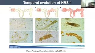 Hepatorenal Syndrome  Part 1  Prof Mohammed Kamal Nassar  27112022 [upl. by Ttoile]