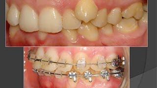 Amazing Deep Bite Correction with Clear Braces Orthodontist [upl. by Eednar]