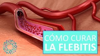 FLEBITIS Qué es y CÓMO CURARLA [upl. by Willett]