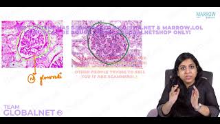 NEPHRITIC SYNDROME By Dr Illa jain khandelwal Pathology by Marrow Video Lecture [upl. by Otiv82]