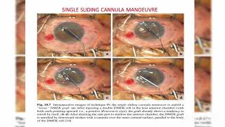 Endothelial keratoplasty DMEK DSEK DLEK PDEK Ophthalmology [upl. by Jea]