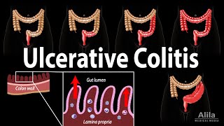 Ulcerative Colitis Pathophysiology Symptoms Risk factors Diagnosis and Treatments Animation [upl. by Piderit]