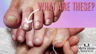 How to Fix White Patches on Toenails [upl. by Anelec]