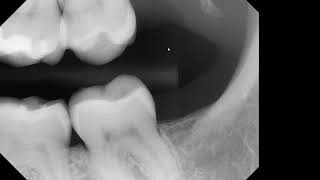 Quiz unknown opacity on posterior bitewing [upl. by Airad]