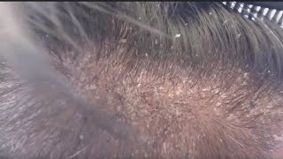 SCALP PSORIASIS  I REALLY SHOULD JUST SHAVE MY HEAD [upl. by Krueger]