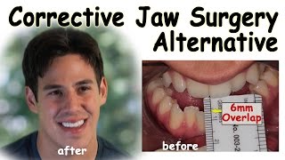 Corrective Jaw Surgery Alternative  Underbite Correction without Surgery [upl. by Larina309]