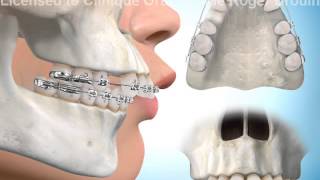 Extractions de dents pour correction surplomb horizontal [upl. by Jennings504]