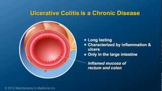 What is Ulcerative Colitis [upl. by Balling]