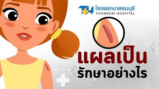 แผลเป็นคีลอยด์ คืออะไร รักษาอย่างไร  โรงพยาบาลธนบุรี [upl. by Atidnan]