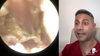 1533  Highly Complex Ear Infection Removal from Collapsing Ear Canal [upl. by Enelaehs]