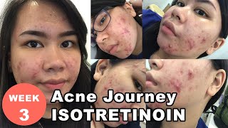 ISOTRETINOIN WEEK 3 MY ACNE JOURNEY [upl. by Onaicilef711]