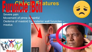 Furuncle In Ear Canal Or Boil In Ear Canal or Abscess with Signs Symptoms amp TreatmentMediSurgi [upl. by Jacoba26]